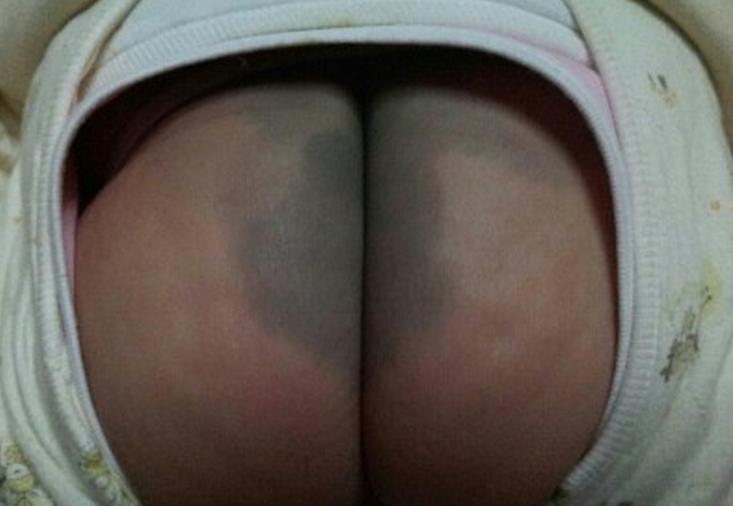 婴儿身上有痣和胎记,婴儿胎记和痣怎么区分