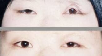 上眼睑轻微外翻有办法治疗吗,眼睑外翻治疗方案