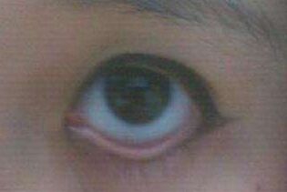 做眼袋后下眼睑外翻有办法解决吗,眼睑外翻怎么办