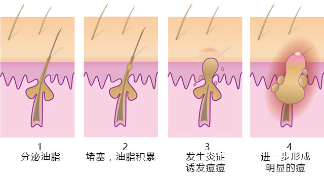 一篇没有噱头不抓眼球但缺切实有用的抗痘护理文章，给有需要的你