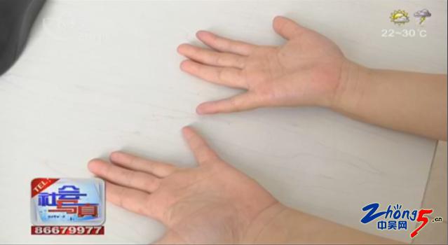 手足口病高发图片,手足口病发病率