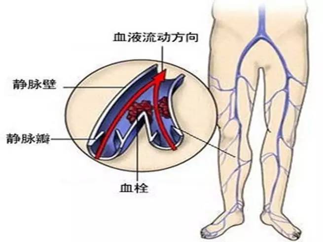 腿上的青筋弯曲是静脉曲张吗,腿上好多青筋是静脉曲张前兆吗