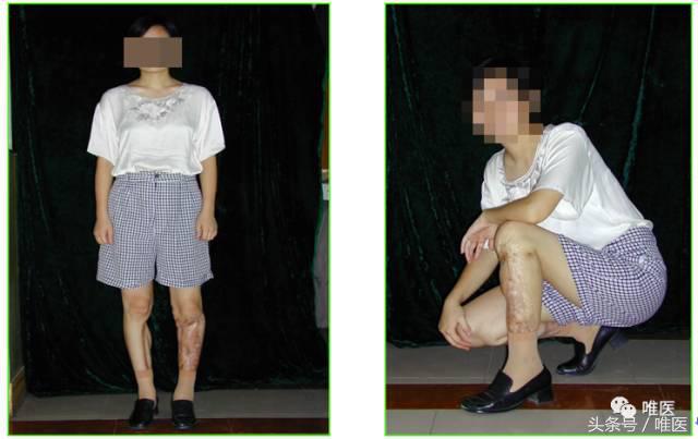 胫骨平台骨缺损处理,胫骨下端部分骨缺损如何植骨