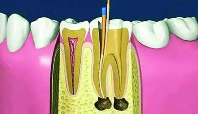 什么是根管治疗流程,什么是根管治疗全过程解说