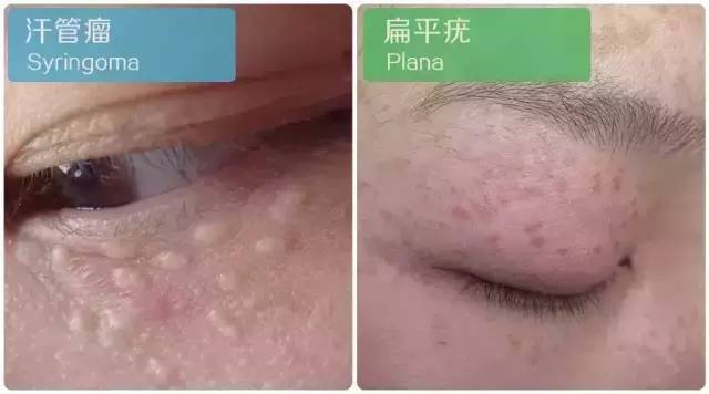 汗管瘤一旦长出很难自己好患者可用激光等治疗