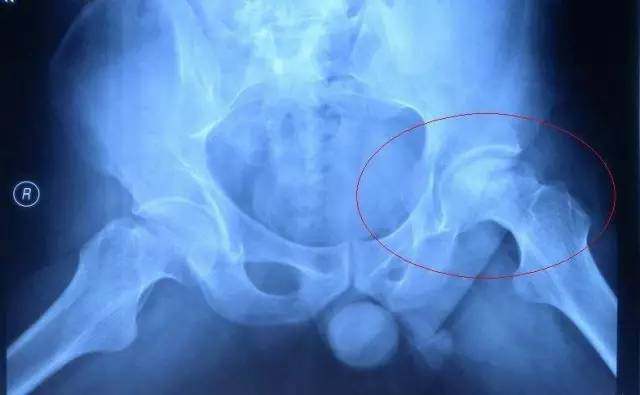 股骨头坏死三期可以痊愈吗,股骨头坏死第三期能骑自行车吗