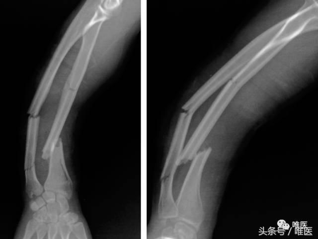 肱骨髓内钉的手术体位,肱骨髓内钉术后康复恢复步骤