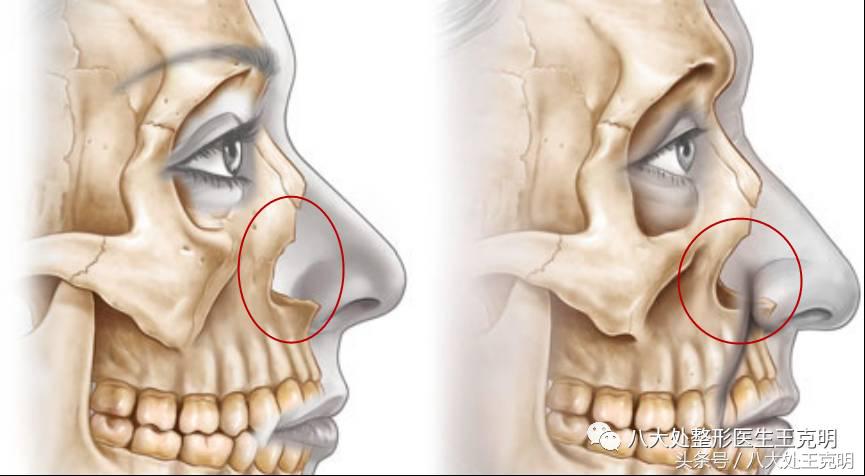 杨紫的法令纹能消除吗,杨紫法令纹很深怎么回事