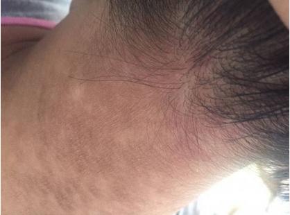 肝癌脸色发黑身体消瘦黄疸怎么办,小孩身体发黑要警惕四种病