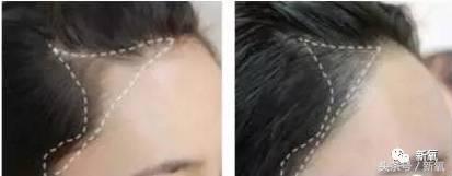 杨幂发际线还会回归吗,杨幂发际线秃到后脑勺