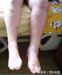 吃什么食物可以预防心脑血管堵塞,十大现象预示血管已堵塞