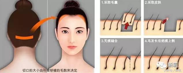 杨幂发际线还会回归吗,杨幂发际线秃到后脑勺