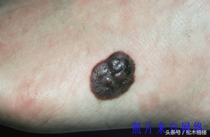 有痣青年要注意这几种痣易恶变,痣长成了大痣可以点掉吗