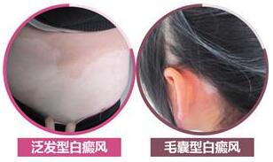 白癜风临床经典30问答