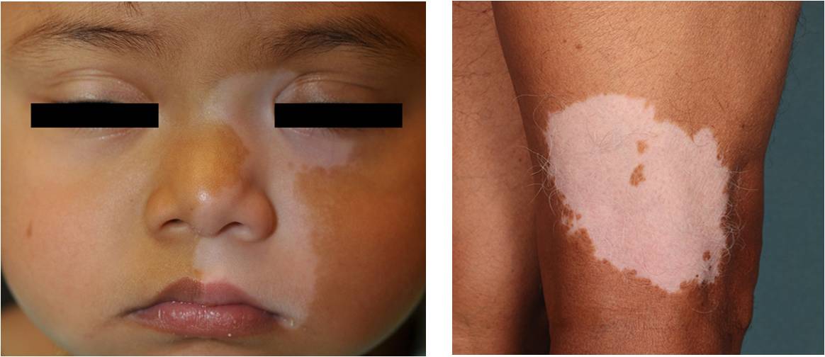 白癜风并不是想象中的那么可怕,关于白癜风的几个疑问