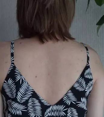 这可能是夏天穿吊带最大的烦恼……这可能是背部痘痘最全攻略