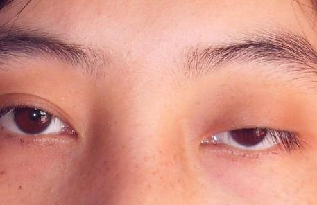 眼肌重症肌无力怎么治疗,重症肌无力治疗要多少钱