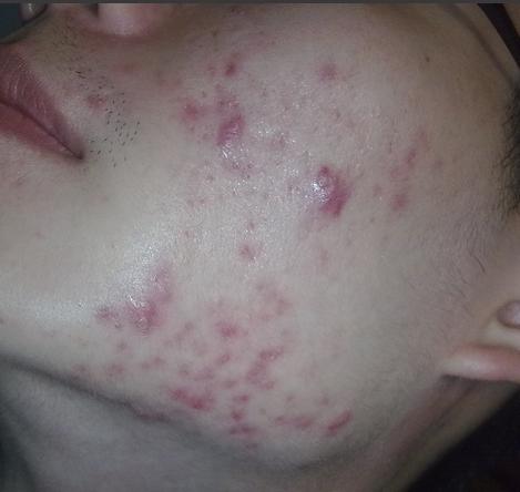 祛痘很多次都不见效,祛痘一瓶搞定