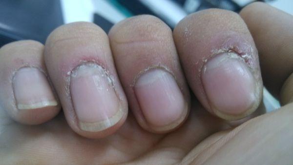 指甲里的黑线是什么物质,指甲若出现白点可能提示哪种情况