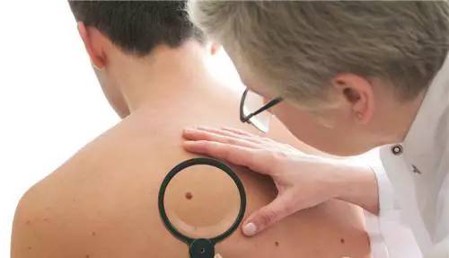 痣是怎么发展成癌症,长痣是患癌的前兆吗