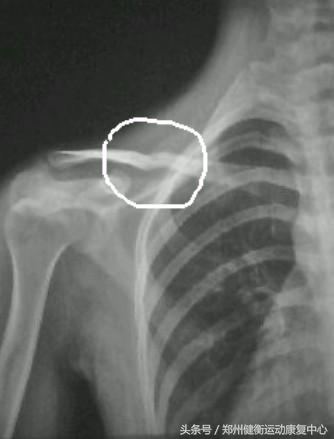 锁骨骨折康复训练,锁骨骨折康复训练小视频