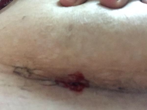 剖腹产伤口有一小块地方没愈合,剖腹产伤口有一个小口没愈合