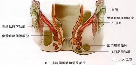 肛周脓肿是不是一辈子都废了,肛周脓肿不疼了但是硬块还拖着呢