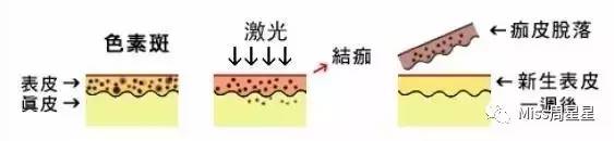 iluminage激光美容仪用法,面部提升紧致美容仪iluminage