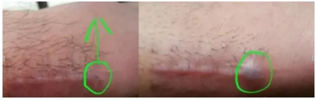 手术线拆完为什么留线头,手术拆完线伤口裂开