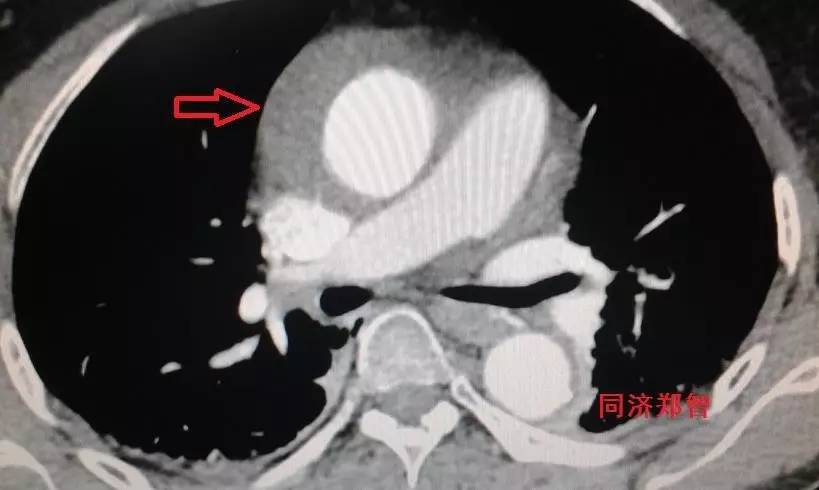 主动脉夹层差点要了老公的命,主动脉夹层兄妹