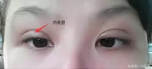 闺蜜割了双眼皮,割了双眼皮后悔了一个月