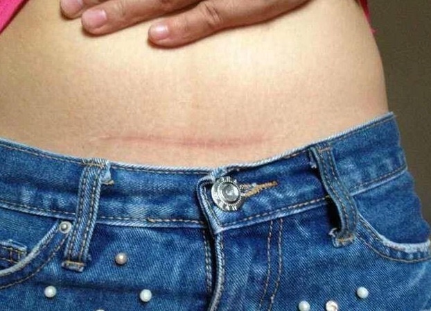 剖腹产产后护理注意什么,剖腹产二胎产后三天饮食注意