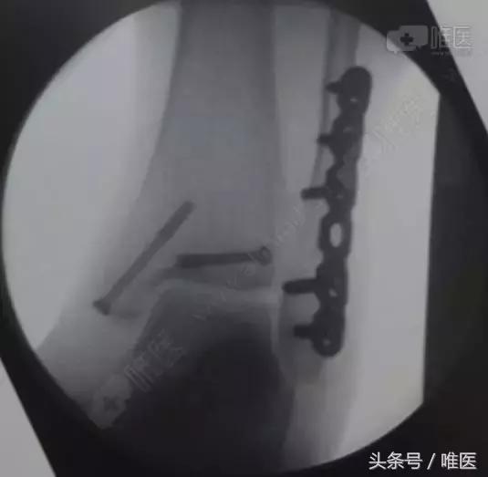 脚踝骨折手术内固定图片,踝关节骨折切开复位内固定术步骤