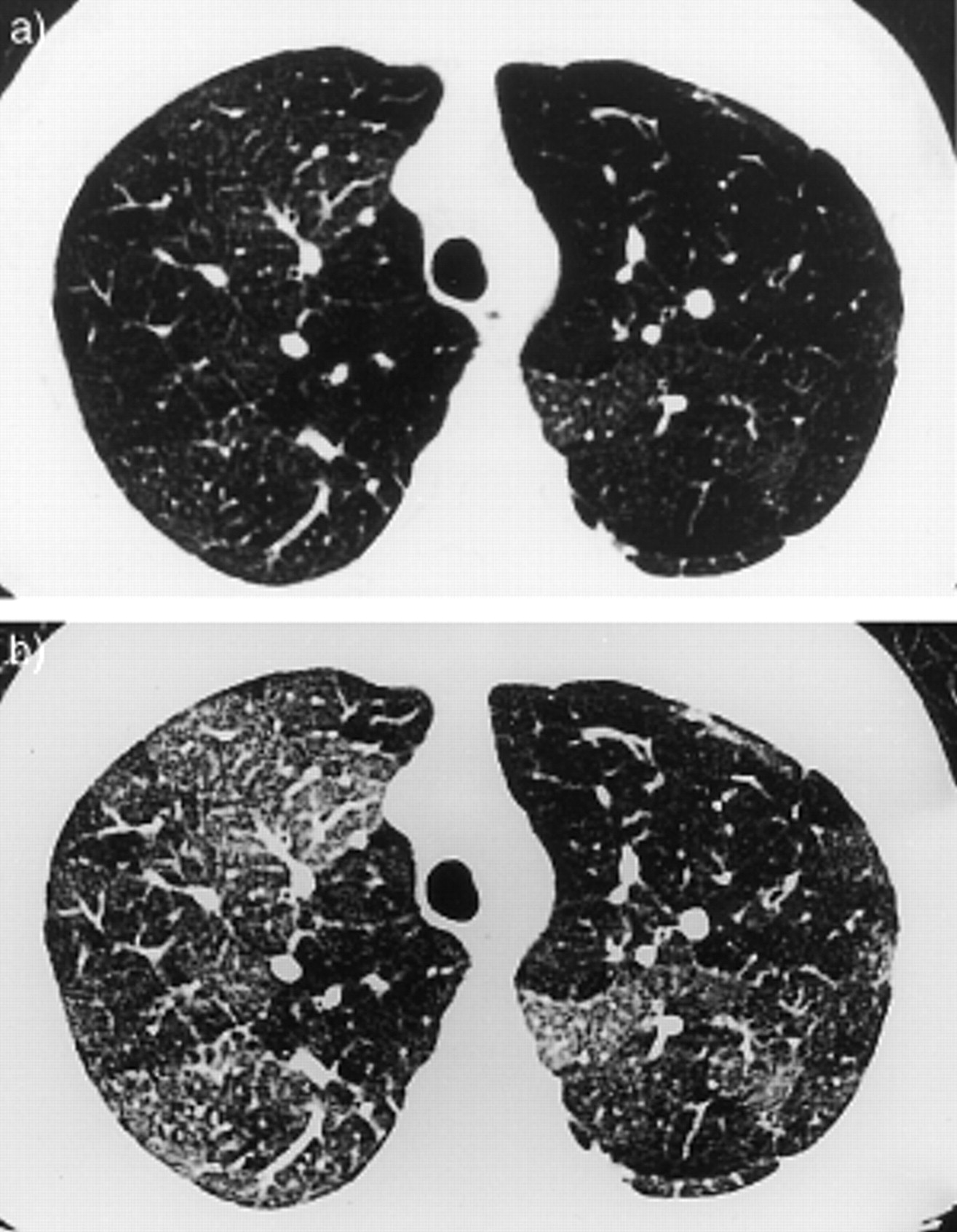 类风湿性关节炎的护理措施,类风湿性关节炎如何保护关节功能