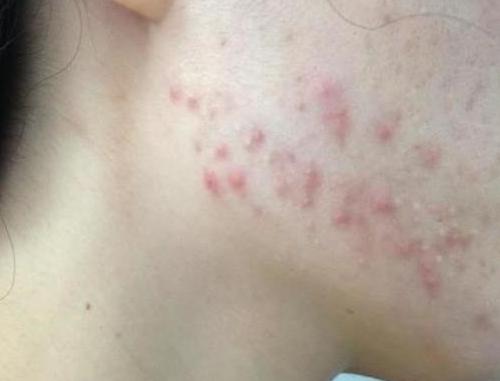 下巴痘痘反复长不停如何正确祛痘,下巴老是长痘痘怎么调理身体啊