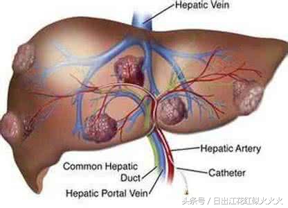 治疗多囊肝的成功案例,肝脏保健与调养论文