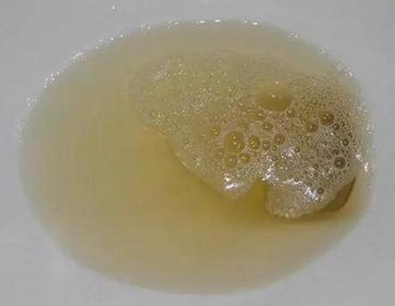 肾病尿检有什么指标是异常的,尿检肾早期损伤指标