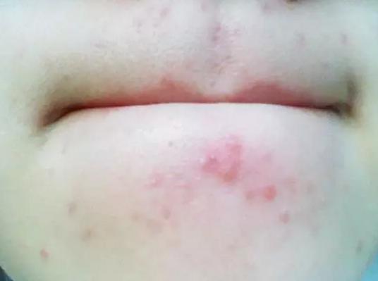 下巴痘痘反复长不停如何正确祛痘,下巴老是长痘痘怎么调理身体啊