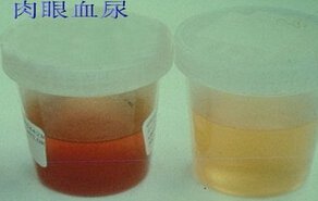 血尿里面有什么成分,血尿的原因和危害及其饮食禁忌