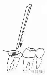 口腔拔牙图片,口腔拔牙麻醉多久消退