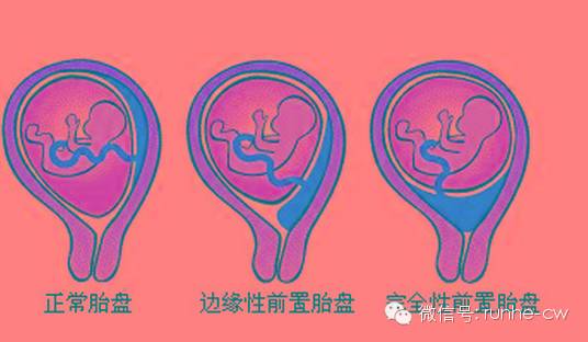 产妇最危险的是什么羊水栓塞,什么情况下产妇会得羊水栓塞