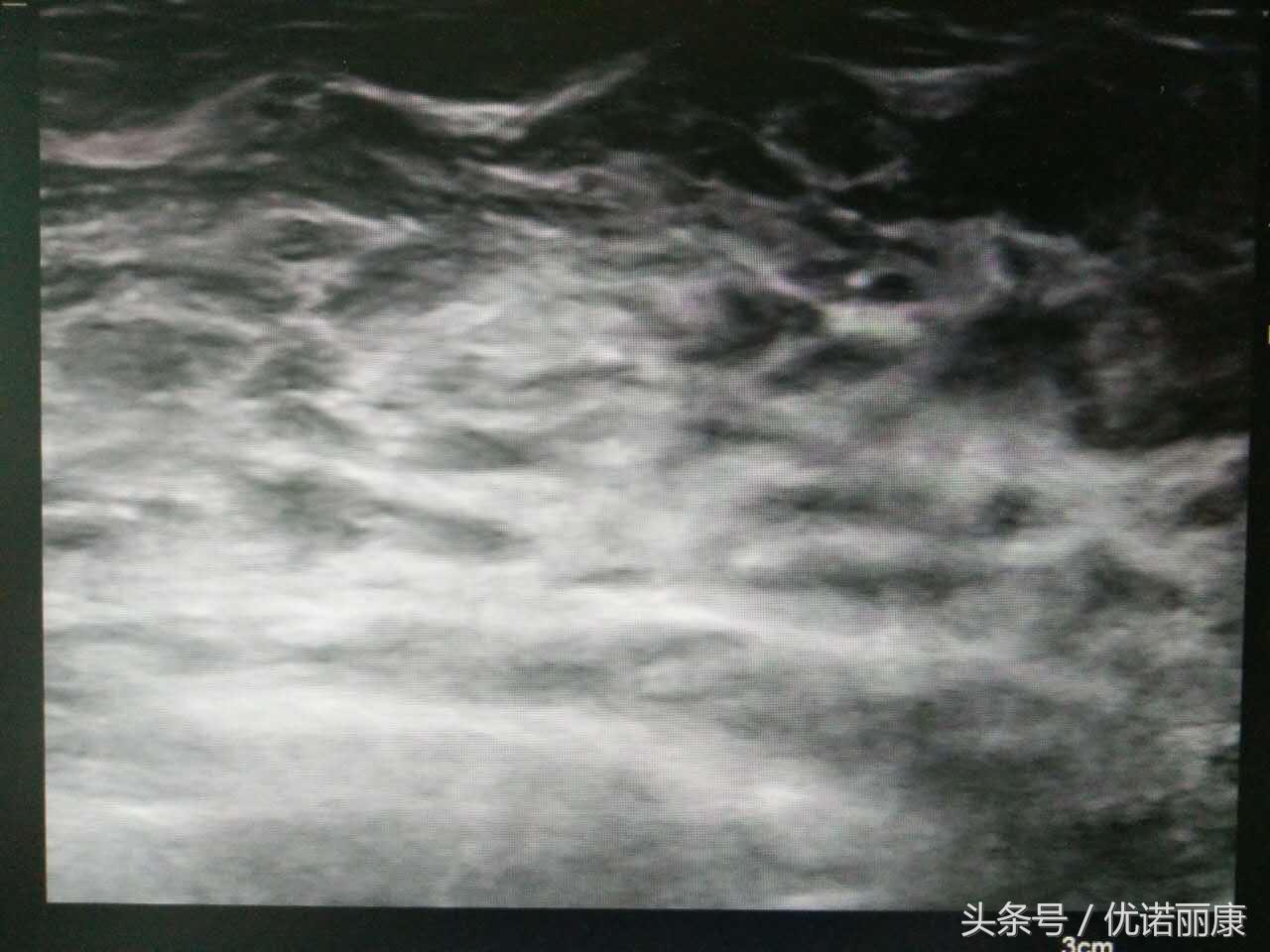 乳腺核磁共振报告专家解读,乳腺病检报告单怎么看