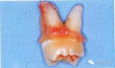 口腔拔牙图片,口腔拔牙麻醉多久消退
