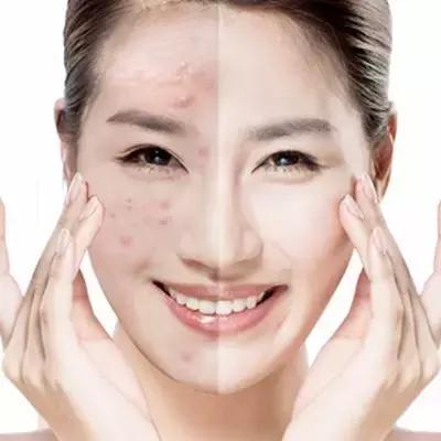 乳液、乳霜太油闷出痘痘怎么办？假的假的