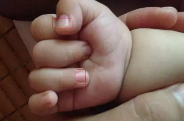 指甲整个掉了需要注意哪些,小孩的指甲应该怎么处理