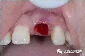 拔牙后出现干槽症有什么症状,拔牙后如何预防干槽症