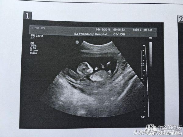 早产宝宝有自带母体抵抗力,早产宝宝也可以很棒