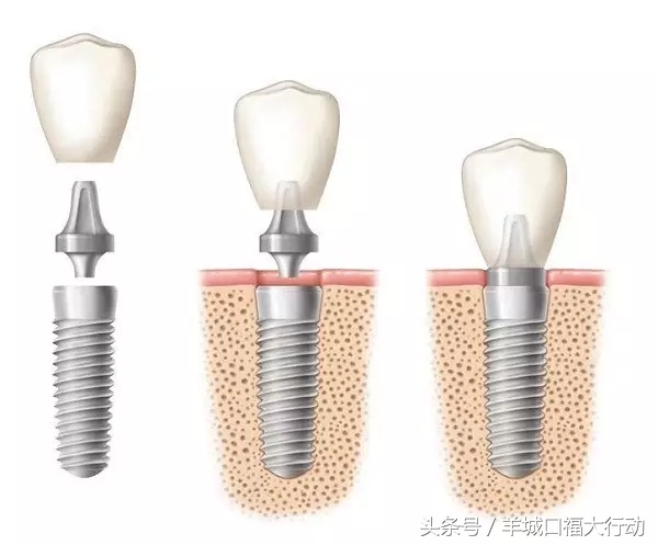 种植牙的八大优势你知道吗,种植牙的优势动画视频
