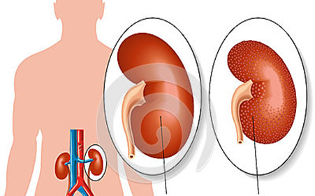 中医有治肾病的中成药吗,中医肾病良方在线阅读