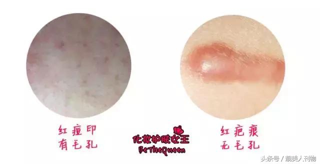 有很多痘印痘坑如何快速消除,常见的痘印类型和祛除痘印的方法